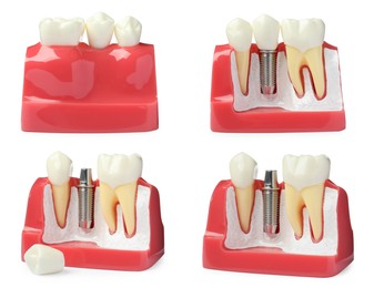 Educational models of gum with dental implant between teeth on white background, collage